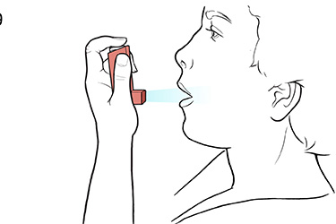 Thumbnail image for "Step-by-Step: Using a Metered-Dose Steroid Inhaler Open Mouth"