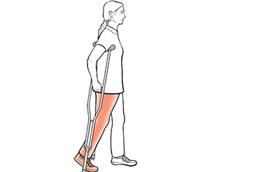 Thumbnail image for "Step-by-Step: Using Crutches with Step Through (Weight Bearing)"