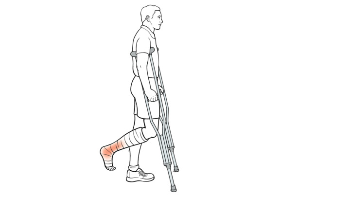 Video - Step-by-Step: Using Crutches with Swing To (Non-Weight Bearing ...