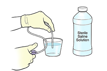 Thumbnail image for "Step-by-Step: Suctioning Your Tracheostomy"
