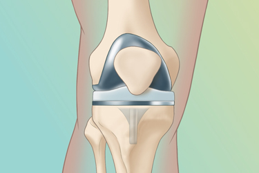 Thumbnail image for "Total Knee Replacement Surgery"