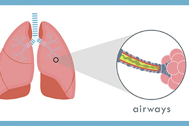 Thumbnail image for "What is Asthma?"