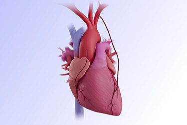 Thumbnail image for "Cirugía de Bypass de la Arteria Coronaria 
"
