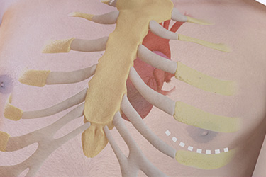 Thumbnail image for "Injerto de Bypass de la Arteria Coronaria Mínimamente Invasivo"