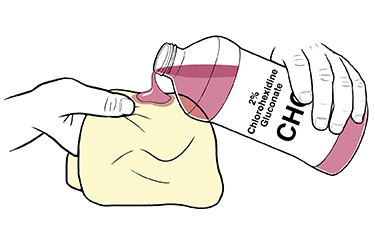 Thumbnail image for "Using Chlorhexidine Gluconate (CHG) Shower Gel Before Surgery"