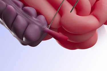 Thumbnail image for "Appendectomy"