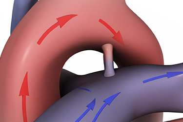 Thumbnail image for "Your Child's Cardiac Catheterization for PDA: Before the Procedure"