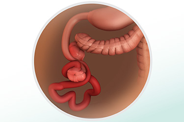 Thumbnail image for "Volvulus in infants: Fast Facts"