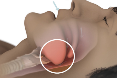 Thumbnail image for "Focus On: Obstructive Sleep Apnea"