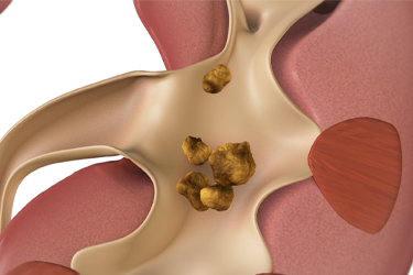 Thumbnail image for "Focus On: Kidney Stones"