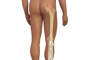 Thumbnail image for "Focus On: Sciatica"