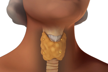 Thumbnail image for "Parathyroidectomy: Before Your Surgery"