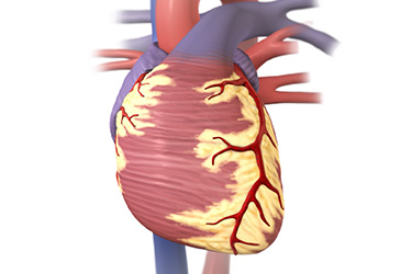 Thumbnail image for "Focus On: Heart Attack"