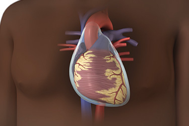 Thumbnail image for "Focus On: Pericardial Effusion"