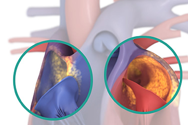 Thumbnail image for "Focus On: Atrial Flutter"