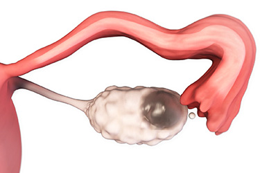 Thumbnail image for "Focus On: Mittelschmerz (Pain During Ovulation)"