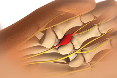 Thumbnail image for "Focus On: Morton Neuroma"