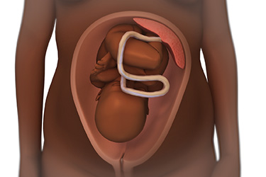 Thumbnail image for "Focus On: Placenta Previa"
