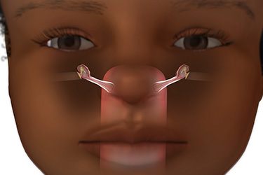 Thumbnail image for "Focus On: Ear Infection (Otitis Media)"