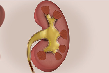 Thumbnail image for "Focus On: Hydronephrosis"