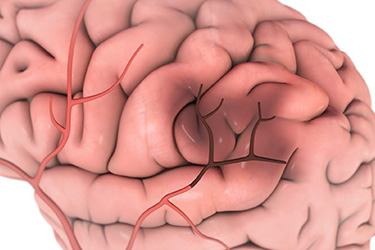 Thumbnail image for "Focus On: Stroke"