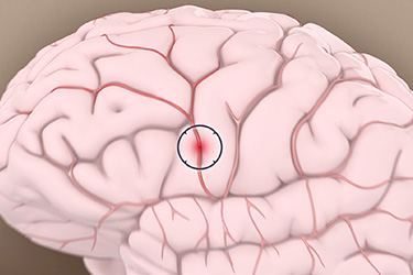 Thumbnail image for "¿Qué es un Ataque Cerebral?"