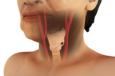 Thumbnail image for "Carotid Artery Procedures: Stroke Prevention"