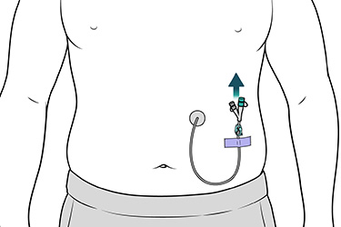 Thumbnail image for "Step by Step: Caring for Your Abdominal Feeding Tube"