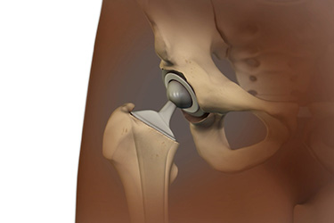 Thumbnail image for "Hip Replacement: Before Your Surgery"