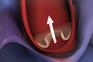 Thumbnail image for "Heart Valve Repair or Replacement: Before Your Surgery"