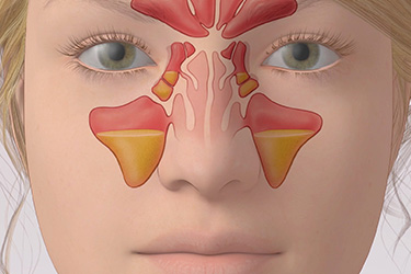 Thumbnail image for "Acute Sinusitis"