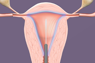 Thumbnail image for "Ablación Endometrial
"