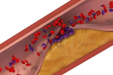 Thumbnail image for "Preventing a Heart Attack or Stroke: How Aspirin May Help"