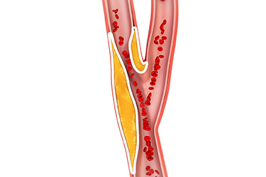 Thumbnail image for "Carotid Endarterectomy: Before Your Surgery"