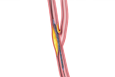 Thumbnail image for "Carotid Artery Stenting: Before Your Procedure"