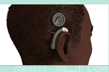 Thumbnail image for "Cochlear Implant: Before Your Surgery"
