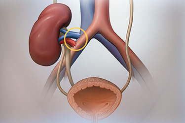 Thumbnail image for "Kidney Transplant: Before Your Surgery"