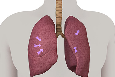 Thumbnail image for "Lung Surgery: Before Your Surgery"