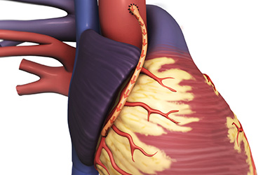 Thumbnail image for "Bypass Surgery for Coronary Artery Disease"