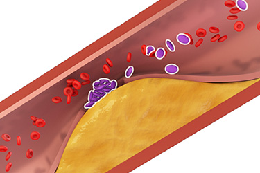 Thumbnail image for "How Plaque Increases the Risk of a Heart Attack"