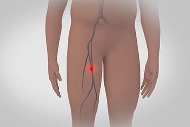 Thumbnail image for "What Is Deep Vein Thrombosis (DVT)?"