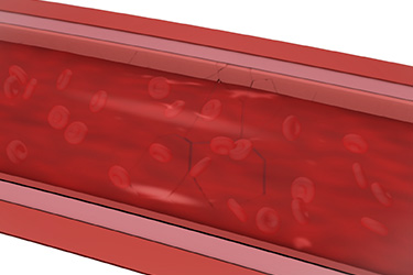 Thumbnail image for "What is High Blood Pressure?"