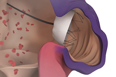 Thumbnail image for "Left Atrial Appendage Closure: Before Your Procedure"
