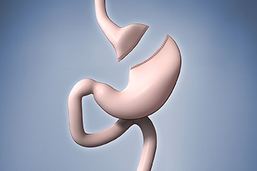 Thumbnail image for "Roux-En-Y Gastric Bypass"