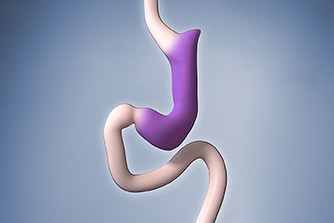 Thumbnail image for "Gastric Sleeve Surgery"