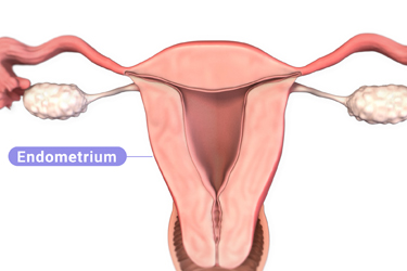 Thumbnail image for "Focus On: Endometrial Cancer"