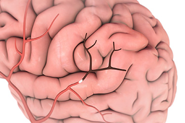 Thumbnail image for "Stroke: Fast Facts"