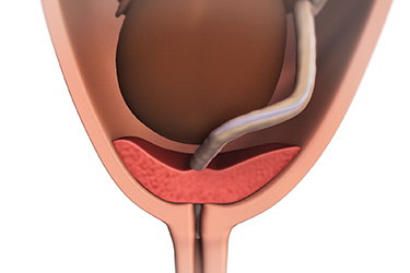 Thumbnail image for "Placenta Previa: Fast Facts"