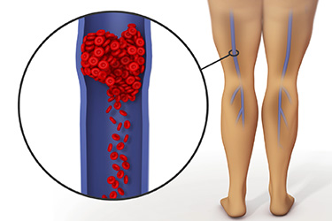 Thumbnail image for "Blood Clot: Fast Facts"