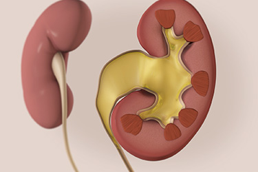 Thumbnail image for "Hydronephrosis: Fast Facts"